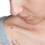 Imagen relacionada con Google Lens ahora identifica marcas en la piel, como lunares y erupciones cutáneas